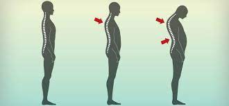 کیفوز چیست؟