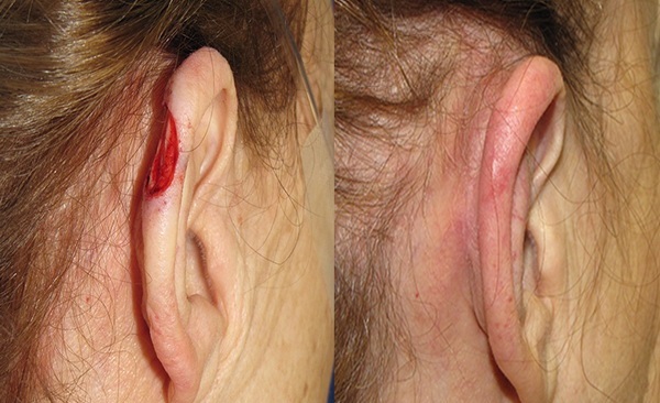 سرطان گوش، علل و علائم آن