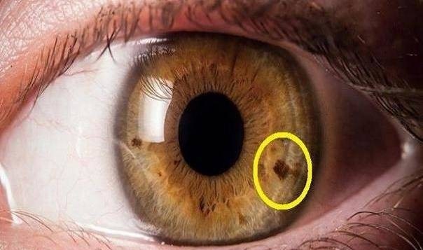 از علت تا درمان سرطان چشم