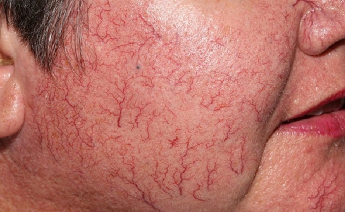 غلظت خون چیست و چگونه درمان میشود؟