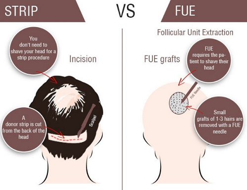چگونگی کاشت مو طبیعی ماندگار قابل رشد به روش fue  و fut برای موی کم حجم