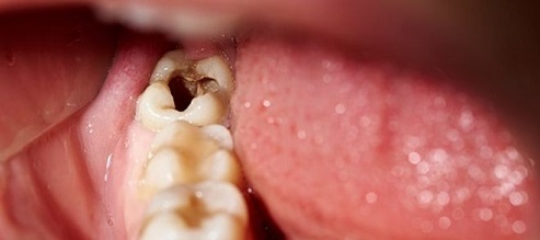 مضرات نوشابه