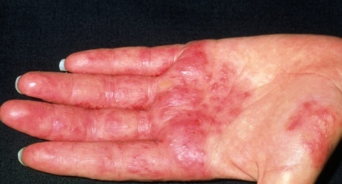 هرآنچه که باید راجع به لکه‌های پوستی بدانیم