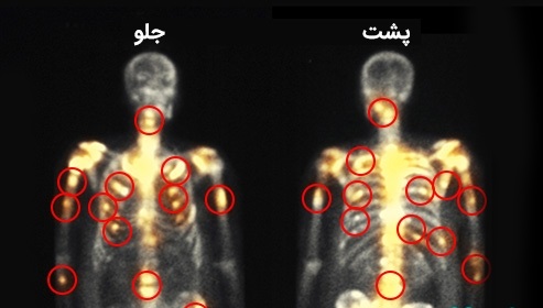 هرآنچه که باید راجع به بیماری مزوتلیوما بدانیم
