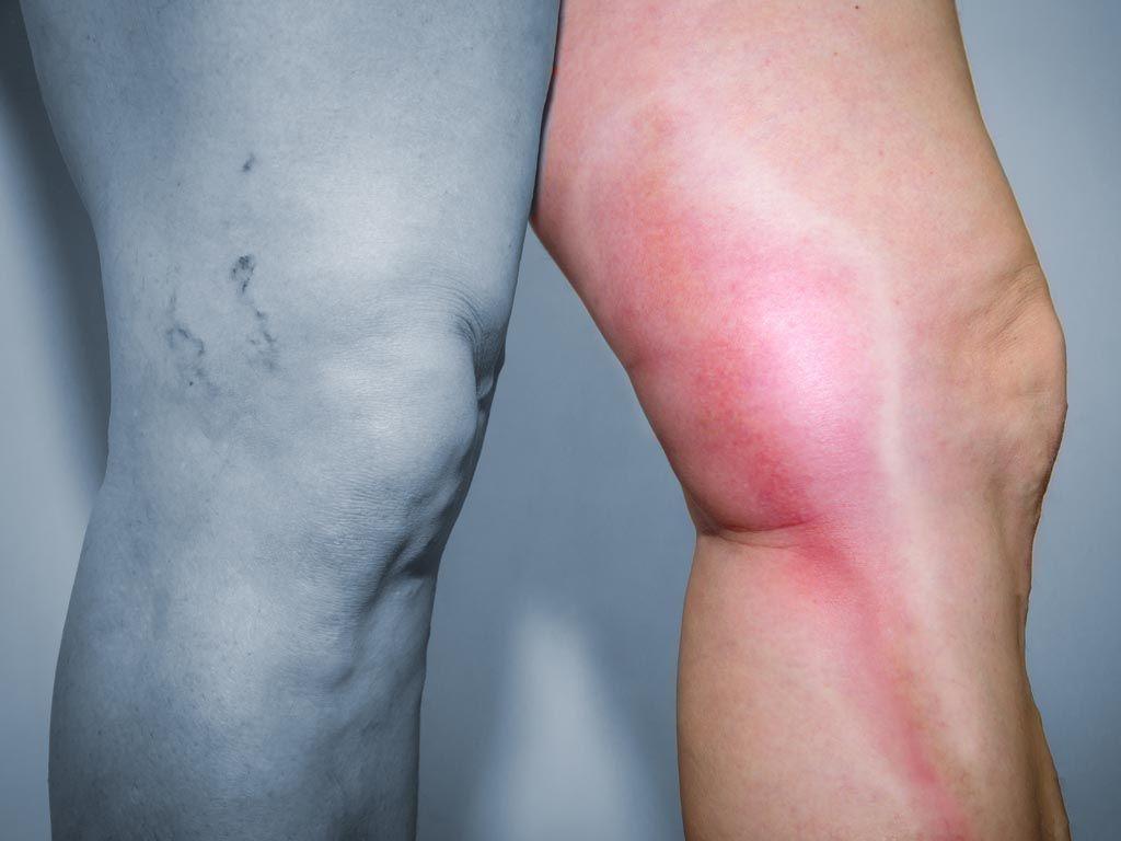 ترومبوز سیاهرگ عمقی