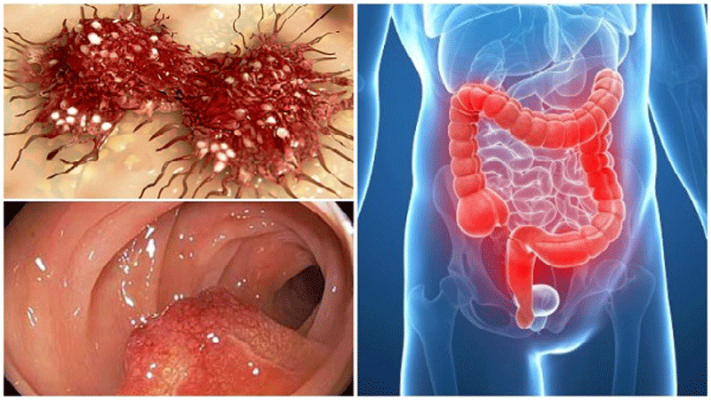 از علت تا درمان سرطان مقعد
