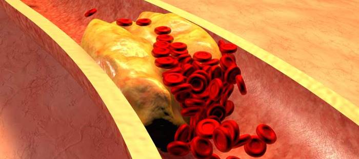 علت و علائم آمبولی چه می باشد؟