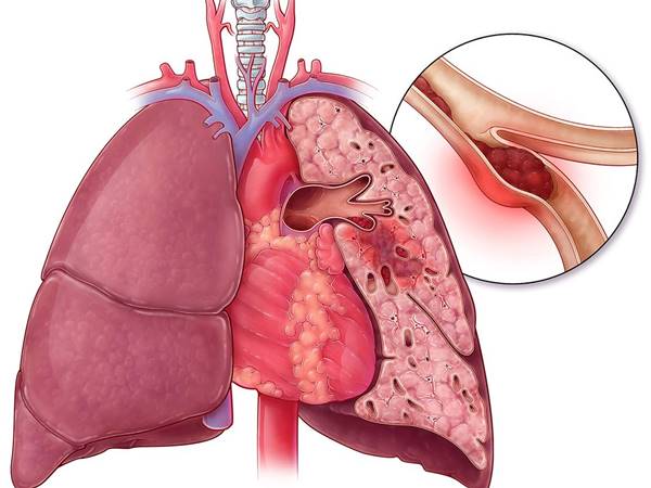 علت و علائم آمبولی چه می باشد؟
