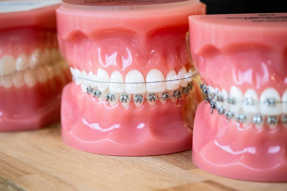 آشنایی با روش ارتودنسی و انواع آن