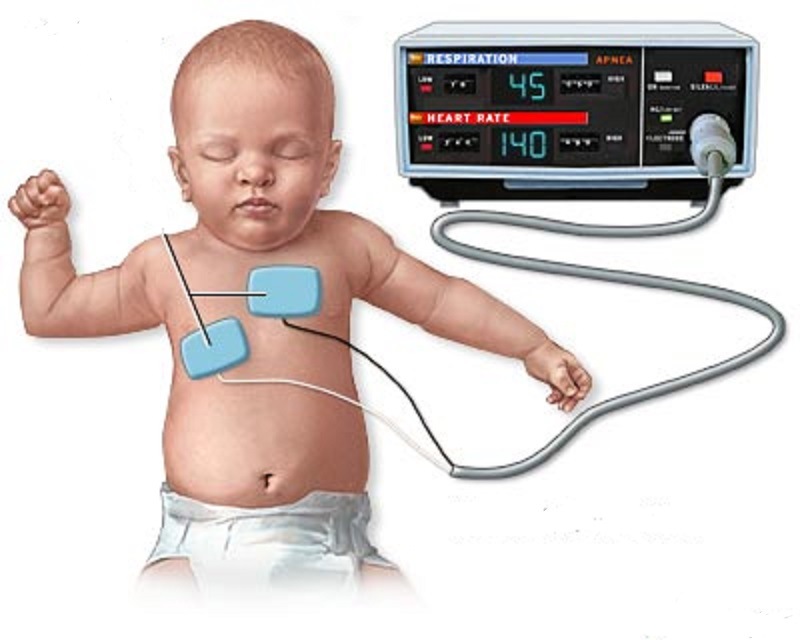 بررسی آپنه و برادیکاردی در نوزادان زودرس