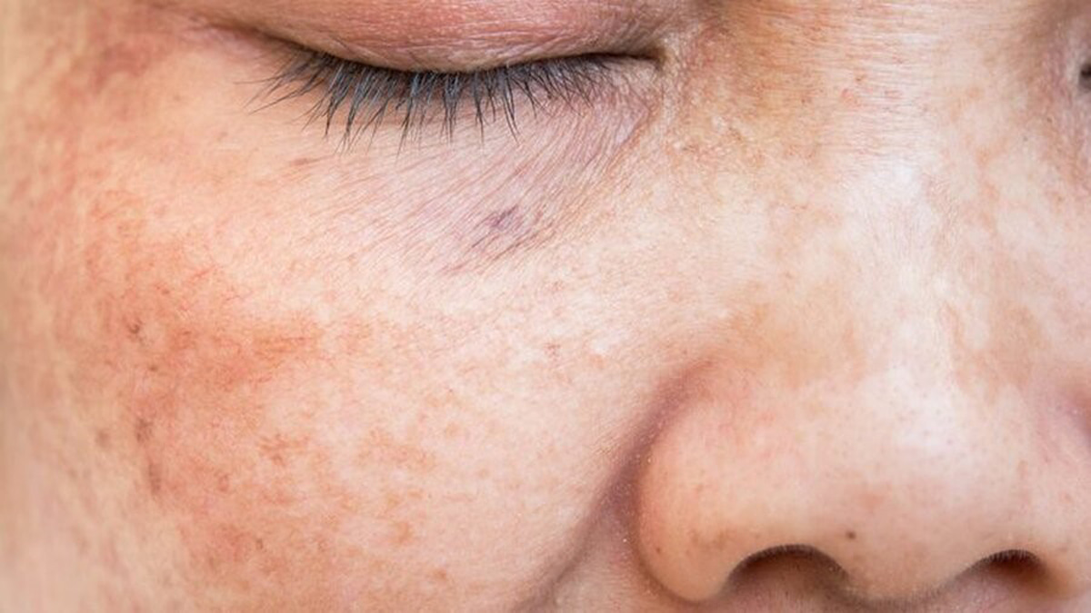 تاثیر وحشتناک آلودگی هوا در ایجاد سرطان پوست که باید بدانید!