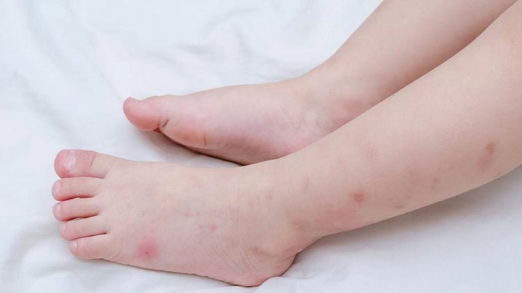 راه‌های جلوگیری از نیش پشه در کودکان