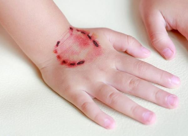 بیماری هاری چیست؟