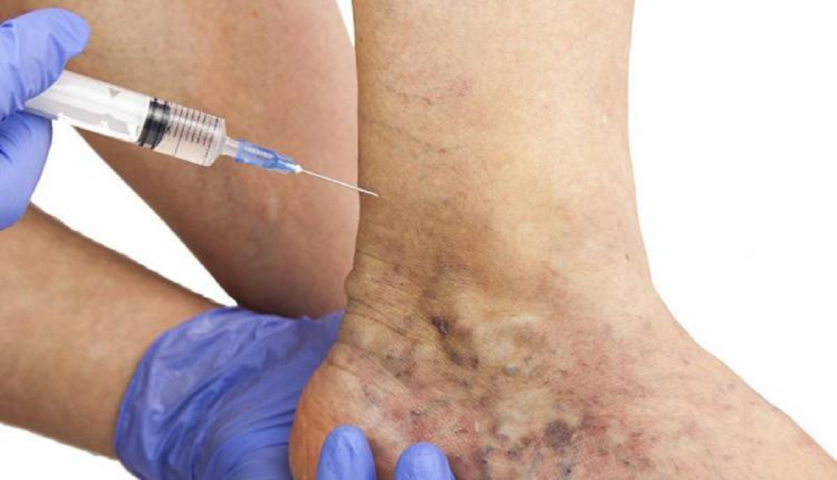 انواع واریس و موثر ترین روش های درمان آن