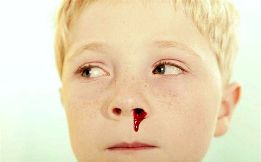 خونریزی بینی در کودکان