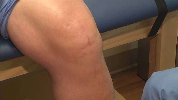 آب آوردن زانو و علائم آن آب آوردن زانو و علائم آن