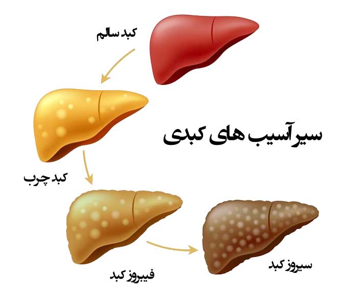 سیروز کبدی چه علائمی دارد؟