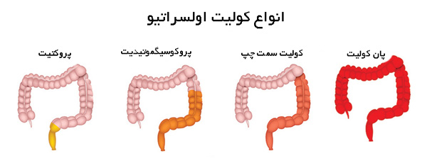از کولیت روده چه می دانید؟