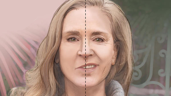 فلج بل یا فلج صورت یا بلز پالسی چیست؟