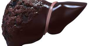 سیروز کبدی چه علائمی دارد؟