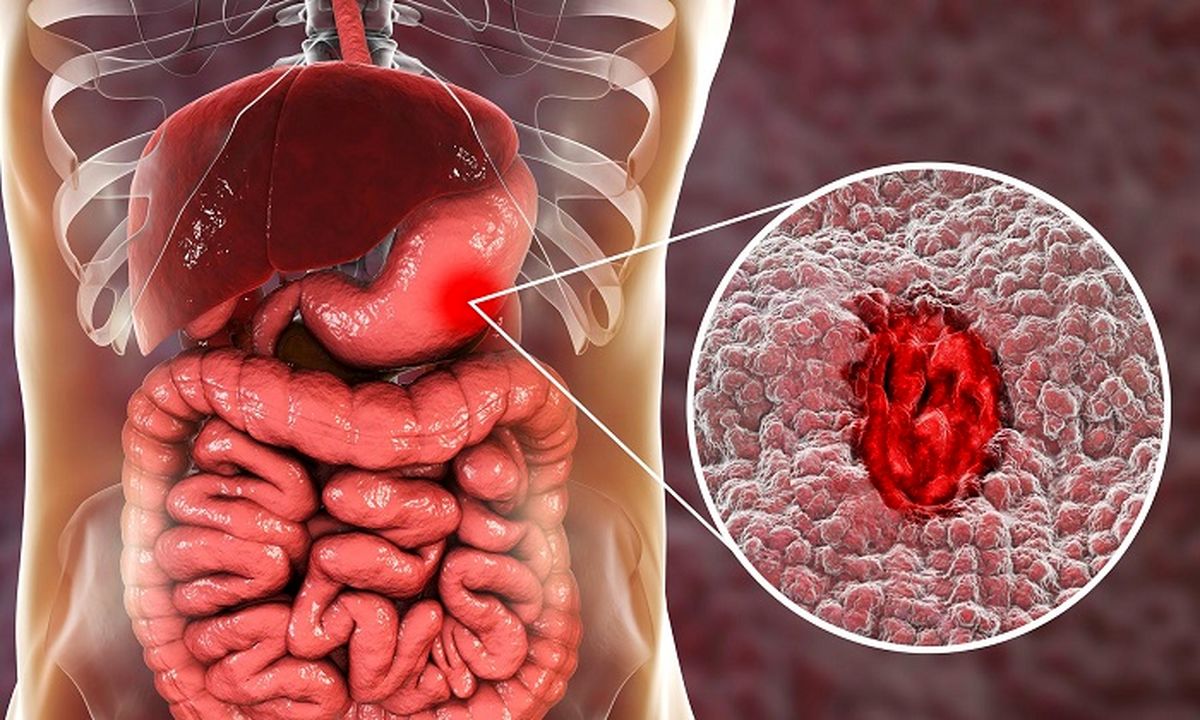 همه چیز راجع به درد دور ناف