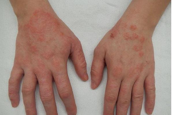 نحوه ی تشخیص و درمان اگزما