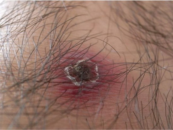 آشنایی با بیماری تیفوس