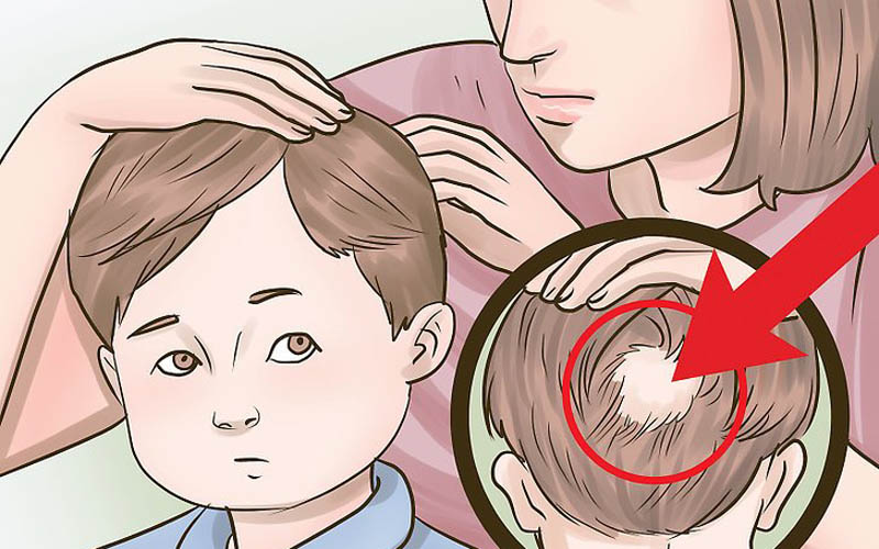 از علت تا درمان ریزش مو در کودکان