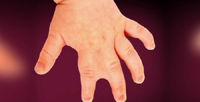 راجع به سینداکتیلی چه میدانید؟