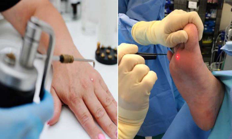 تفاوت زگیل و میخچه در چیست؟