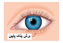 عمل بلفاروپلاستی: افراد مناسب و نامناسب برای انجام عمل زیبایی پلک