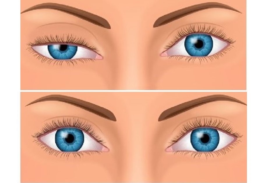 با انواع افتادگی پلک و راه های درمانی آن آشنا شوید