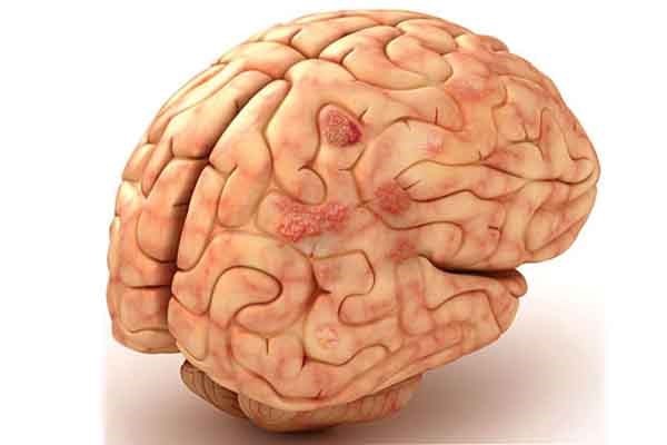 با بیماری آنسفالیت آشنا شوید