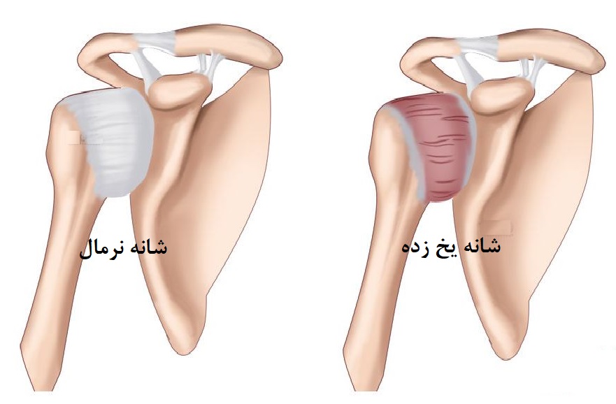 شانه یخ زده چیست؟ علائم و درمان