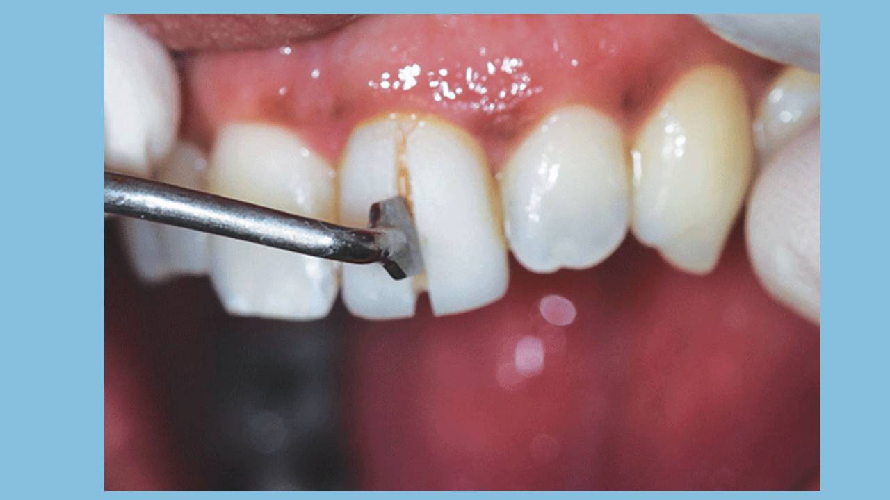 کامپوزیت دندان چیست؟ آیا از اثرات مخرب آن روی دندان خبر دارید؟