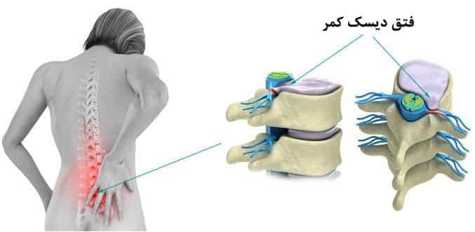 فتق دیسک کمر