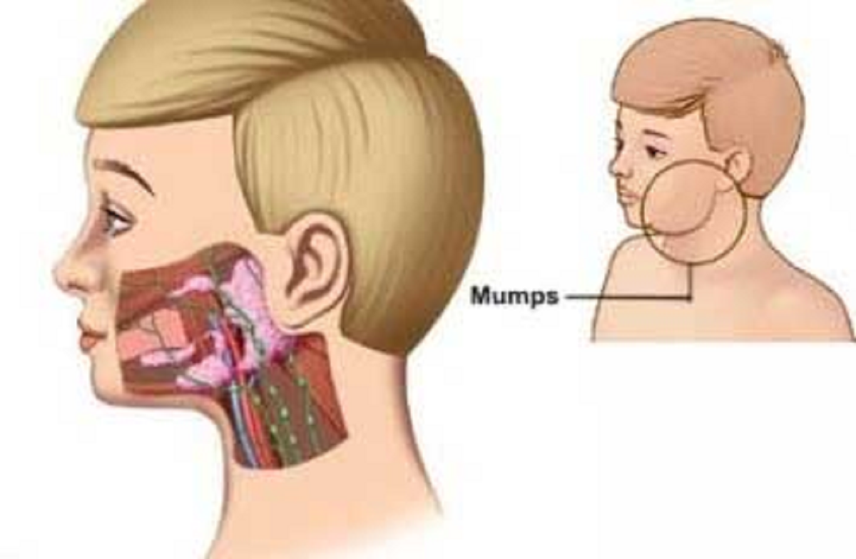 نشانه ها و راههای درمان بیماری اوریون