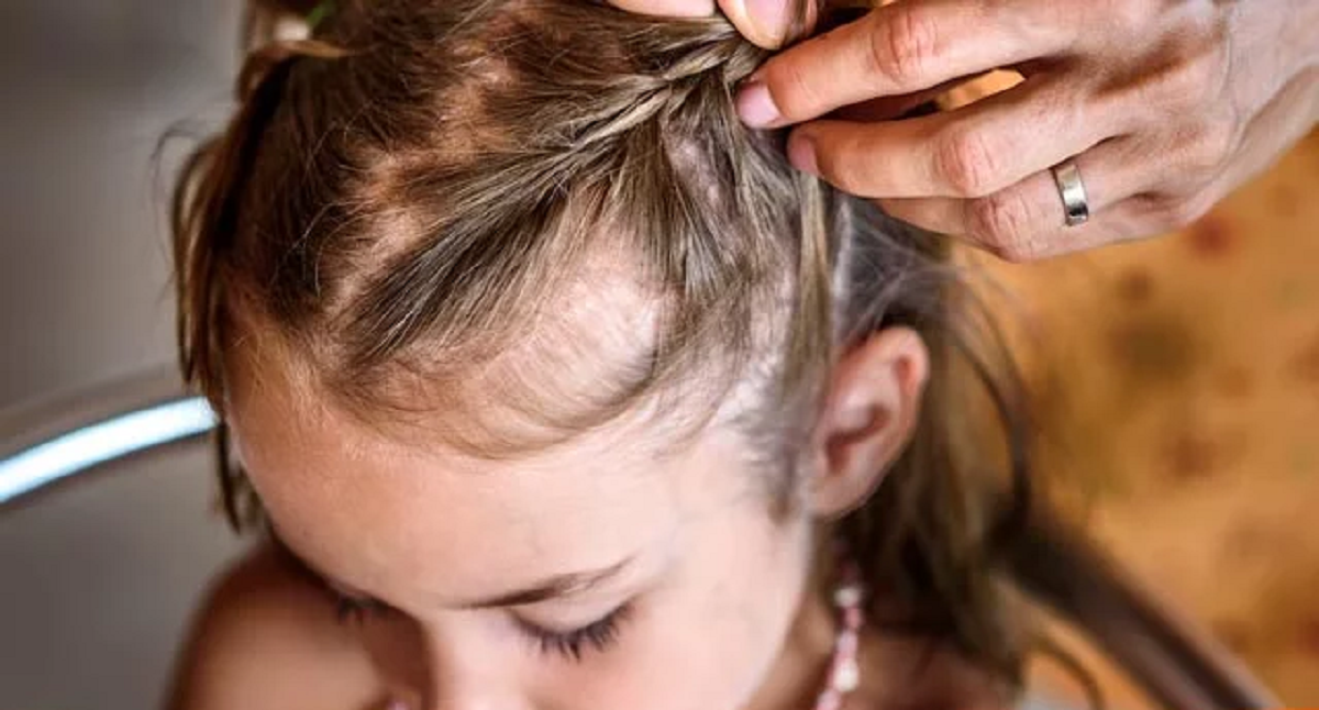 هر آنچه باید درباره علل ریزش مو در کودکان و راه درمان آن ها بدانید