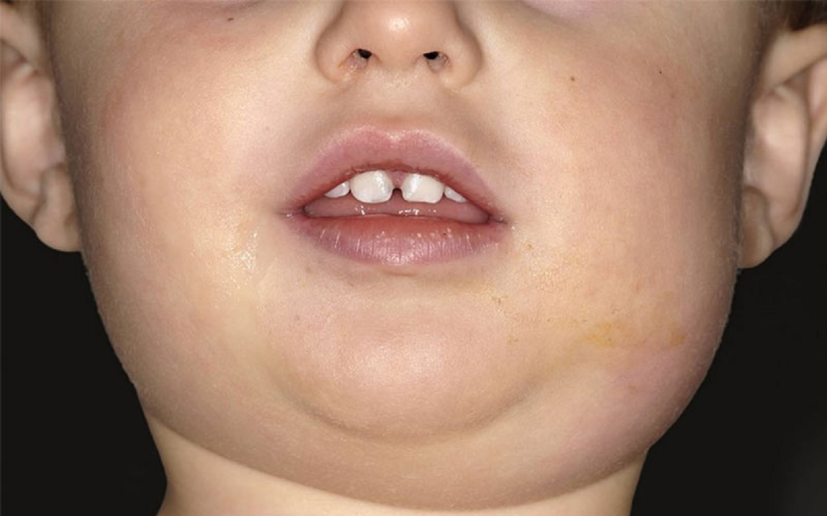 نشانه ها و راههای درمان بیماری اوریون