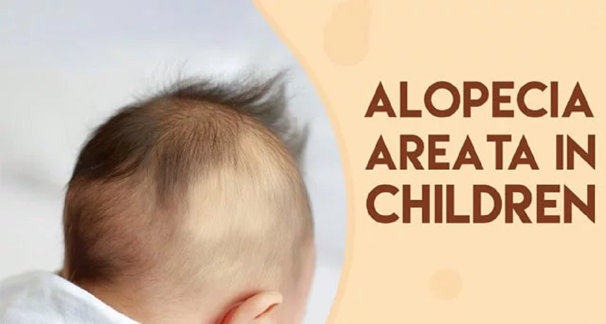 هر آنچه باید درباره علل ریزش مو در کودکان و راه درمان آن ها بدانید