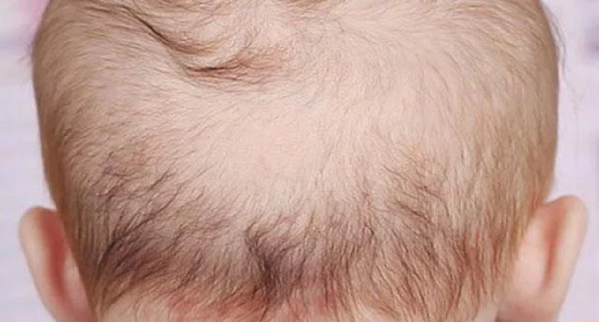 هر آنچه باید درباره علل ریزش مو در کودکان و راه درمان آن ها بدانید