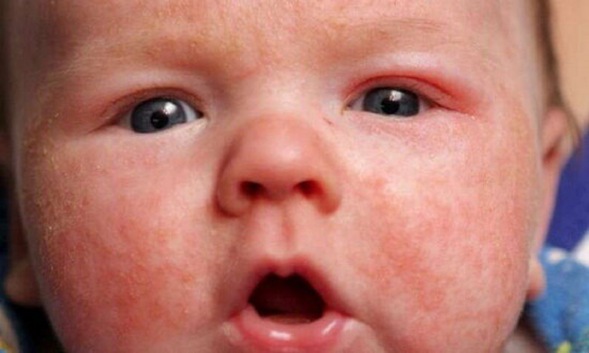 علائم سرخک در کودکان، راههای تشخیص و درمان آن