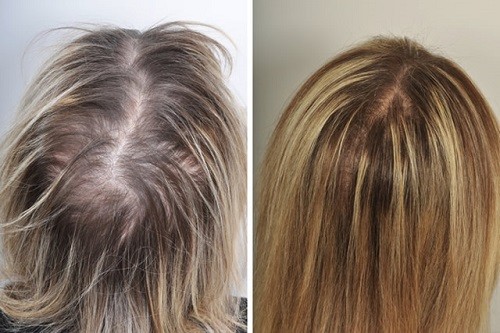 چگونگی کاشت مو طبیعی ماندگار قابل رشد به روش fue  و fut برای موی کم حجم