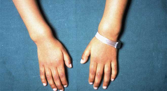 راشیتیسم یا نرمی استخوان چیست؟