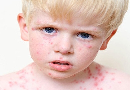 همه چیز راجع به سندروم ری