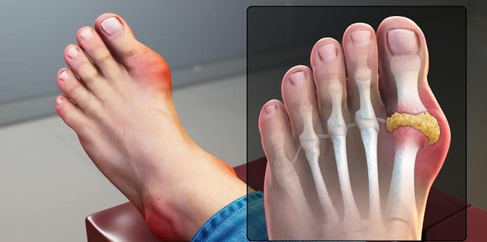 نقرس چیست و چگونه درمان میشود؟