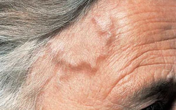 گرانولوماتوز وگنر چیست؟