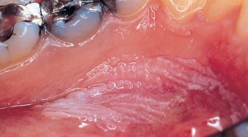 لکوپلاکی چیست؟