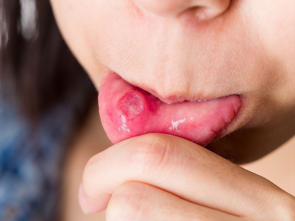 همه چیز درباره بیماری بهجت