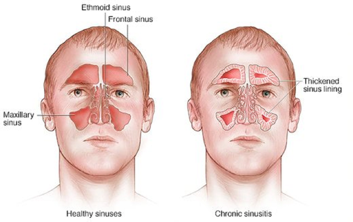 علائم و نشانه‌های سینوزیت مزمن و حاد و علل، تشخیص، درمان و پیشگیری از آن